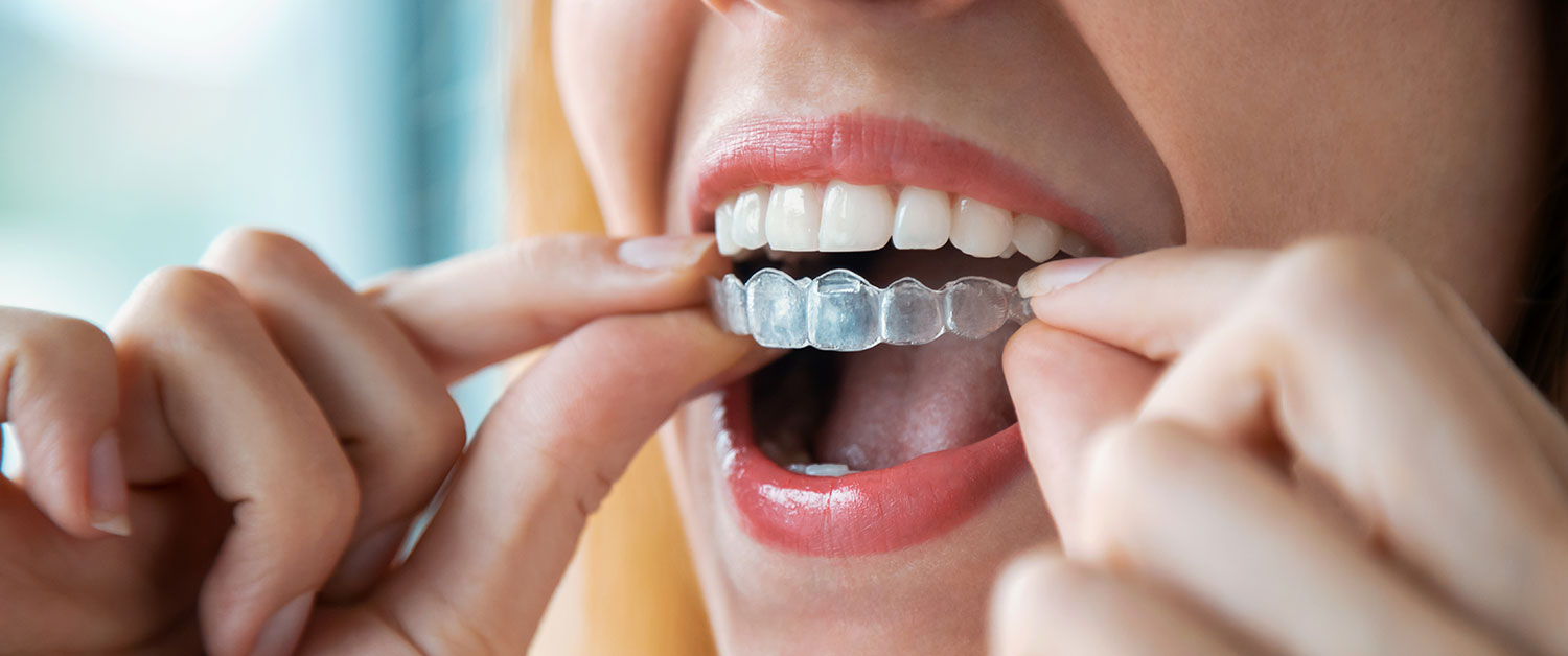 Girl wearing Invisalign tray